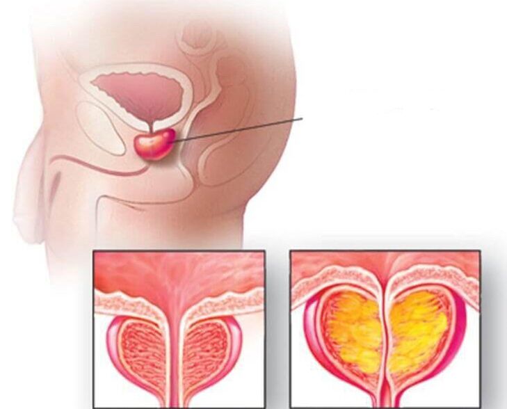 Lage der Prostata, normale Prostata und vergrößert bei chronischer Prostatitis