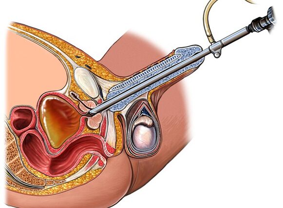 Behandlung von Prostatitis