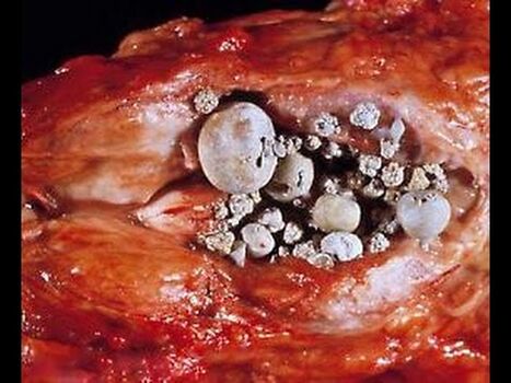 Kalkhaltige Prostatitis