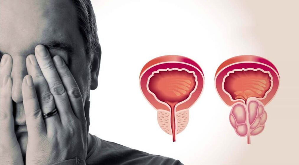 Gesunde und entzündete Prostata